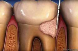 зубной камень, стоматология