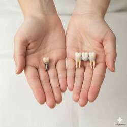 одномоментная имплантация